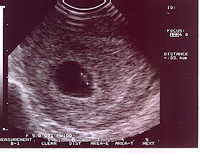 2000/11/07(第七周)  此時小餅乾像米粒大小(兩個白色十字中間那個）什麼也看不出來。只能確定小餅乾是在子宮內，不是子宮外孕。中間有較淡的白色是小餅乾的心臟。